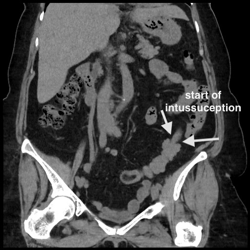 Distal Colocolic Intussusception Due To Lipoma Epiploic Appendagitis