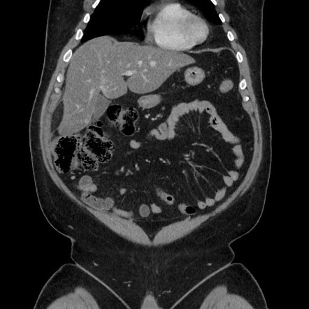 Omental Infarct Right Upper Quadrant Radiology Case Radiopaedia Org