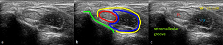 Low Lying Peroneus Brevis Muscle Belly Radiology Reference Article