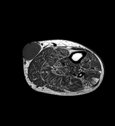 Dermatofibrosarcoma Protuberans Dfsp Image Radiopaedia Org