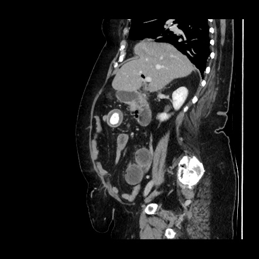 Gallstone Ileus Image Radiopaedia Org