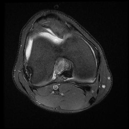 Cyclops Lesion Radiology Case Radiopaedia Org