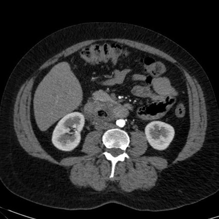 Duodenal Diverticulitis Radiology Reference Article Radiopaedia Org