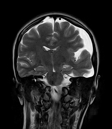 Arachnoid Cyst Middle Cranial Fossa Image Radiopaedia Org