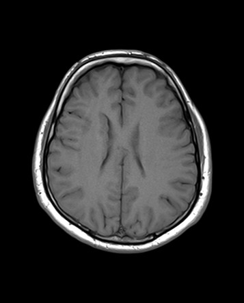 Subependymal Grey Matter Heterotopia Image Radiopaedia Org