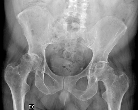 Avascular Necrosis Of The Hip Crescent Sign Appearance Image