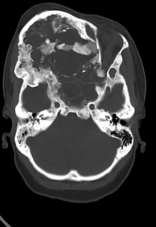 Craniofacial Fibrous Dysplasia Radiology Reference Article