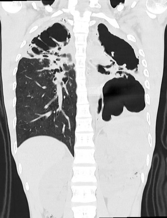 Severe Pulmonary Tuberculosis Radiology Case Radiopaedia Org