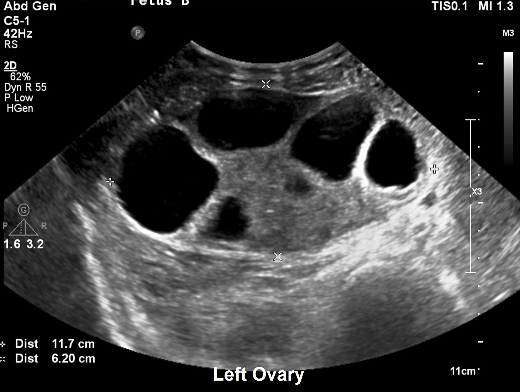 Ovarian Hyperstimulation With Torsion Image Radiopaedia Org