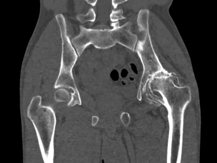 Avascular Necrosis Of The Left Hip Radiology Case Radiopaedia Org