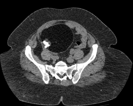 Ovarian Mature Cystic Teratoma Radiology Case Radiopaedia Org