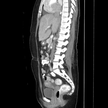 Mesenteric Desmoid Tumor Image Radiopaedia Org