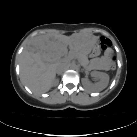 Hepatic Alveolar Echinococcosis Image Radiopaedia Org