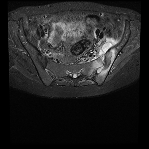 Septic Sacroiliitis Brucellosis Image Radiopaedia Org