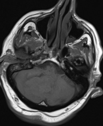 Intracerebellar Haemorrhage Hyperacute Radiology Case Radiopaedia Org