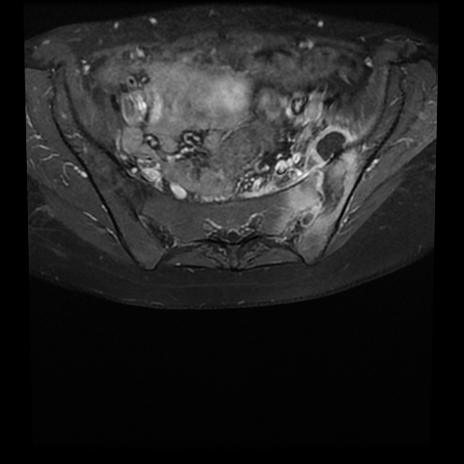 Septic Sacroiliitis Brucellosis Image Radiopaedia Org