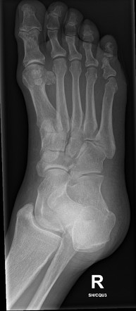 Fractured Lateral And Bipartite Medial Hallux Sesamoid Bones Image