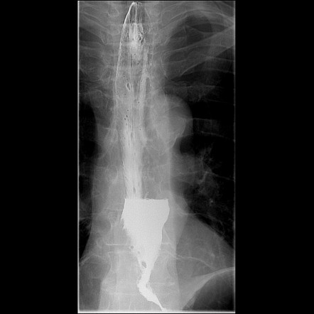 Oesophageal Carcinoma Radiology Case Radiopaedia Org