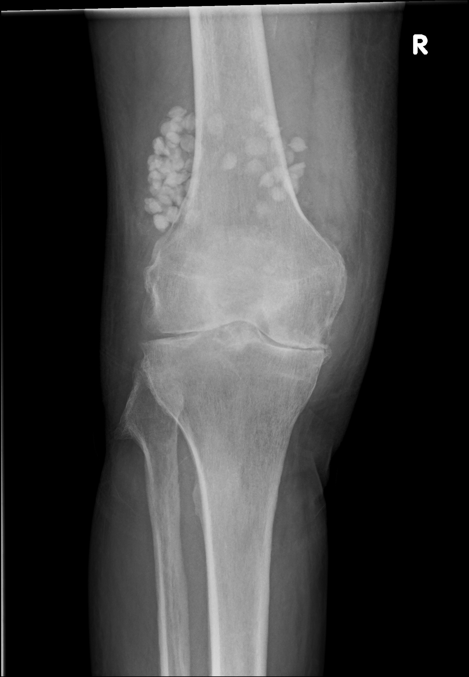 Antibiotic Beads Image Radiopaedia Org