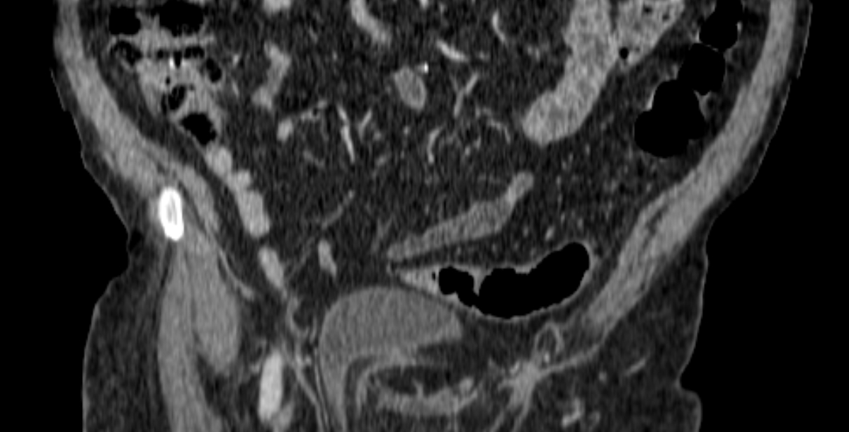 Urinary Bladder Hernia Into The Inguinal Canal Image Radiopaedia Org