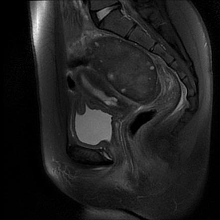 Ovarian Torsion Image Radiopaedia Org