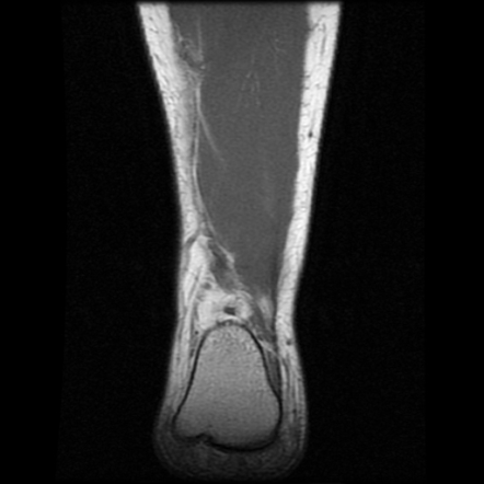 Accessory Soleus Muscle Image Radiopaedia Org