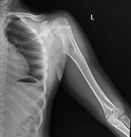 Osteochondroma Humerus Radiology Case Radiopaedia Org