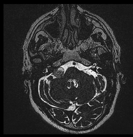 Vestibular Schwannoma Radiology Case Radiopaedia Org