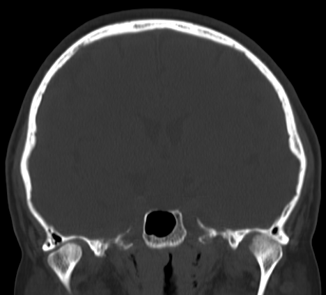 Rathke S Cleft Cyst Image Radiopaedia Org