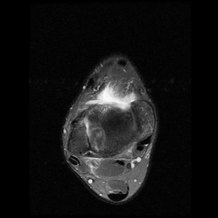 Talar Dome Osteochondral Injury With Detached Fragment Image