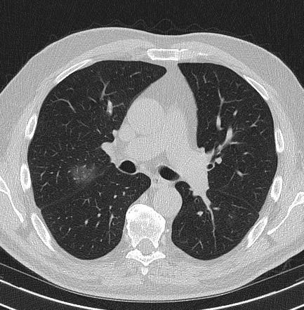 Focal Ground Glass Opacification Radiology Reference Article