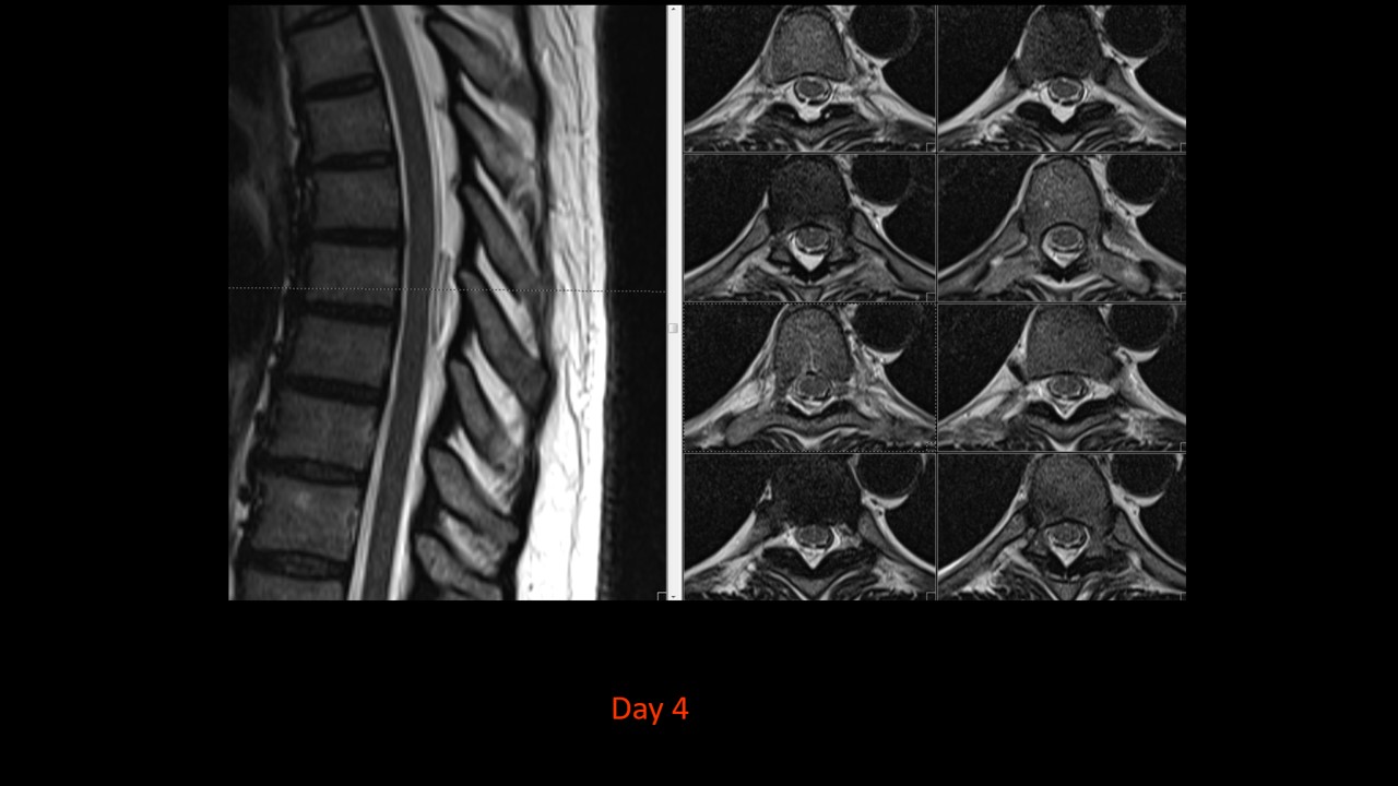 Spontaneous Spinal Epidural Hematoma Image Radiopaedia Org