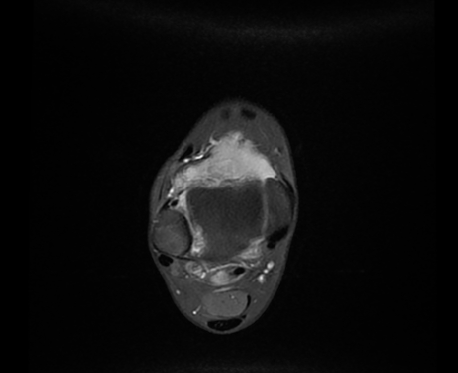 Pigmented Villonodular Synovitis Ankle Image Radiopaedia Org