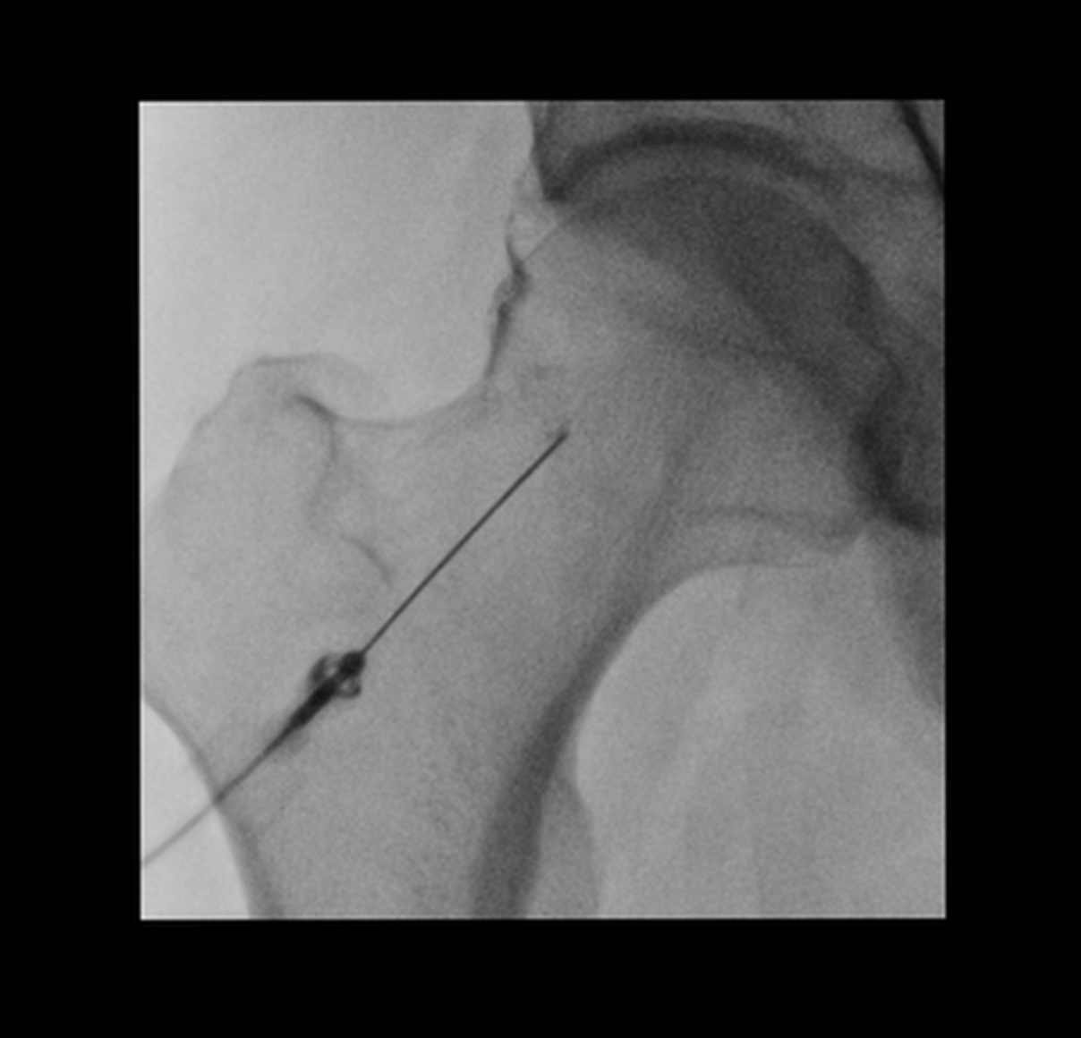 Hip Arthrogram Injection Fluoroscopic Guided Image Radiopaedia Org