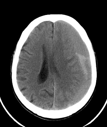 Subdural Haematoma Acute On Chronic Radiology Case Radiopaedia Org