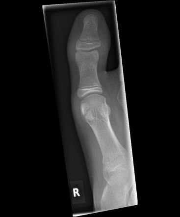 Salter Harris Ii Fracture Great Toe Proximal Phalanx Radiology Case