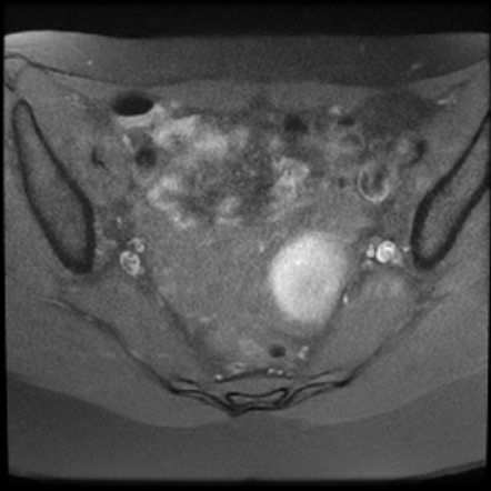 Hemorrhagic Ovarian Cyst Image Radiopaedia Org