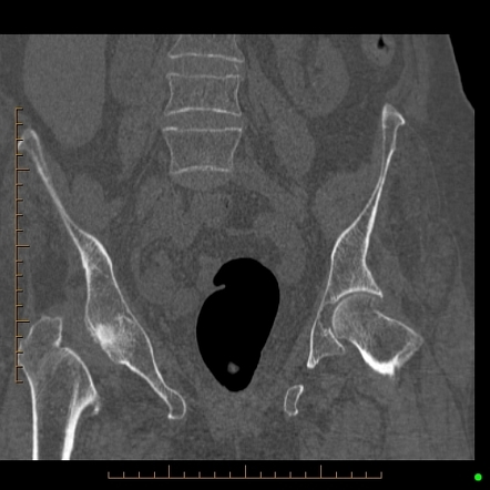 Sacral Insufficiency Fracture Image Radiopaedia Org