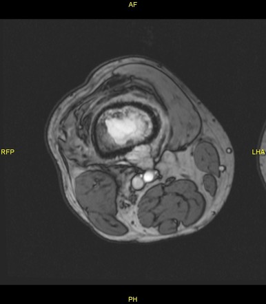 Telangiectatic Osteosarcoma Tos Image Radiopaedia Org