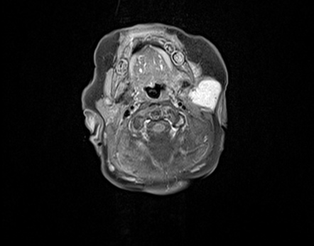 Parotid Infantile Hemangioma Radiology Reference Article Radiopaedia Org