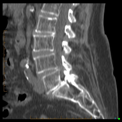 Sacral Insufficiency Fracture Image Radiopaedia Org