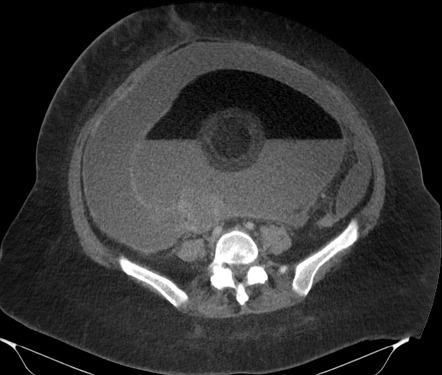 Mature Cystic Ovarian Teratoma Radiology Case Radiopaedia Org