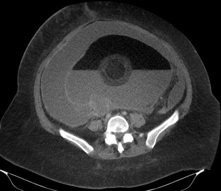 Mature Cystic Ovarian Teratoma Radiology Reference Article