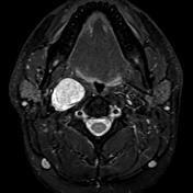 Vagal Schwannoma Radiology Reference Article Radiopaedia Org