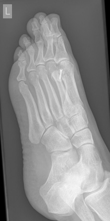 Bipartite Hallux Sesamoid Diastasis Image Radiopaedia Org