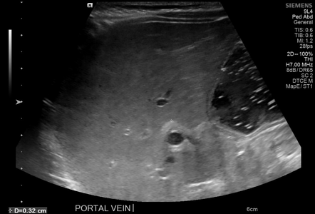 Triangular Cord Sign Biliary Atresia Radiology Reference Article