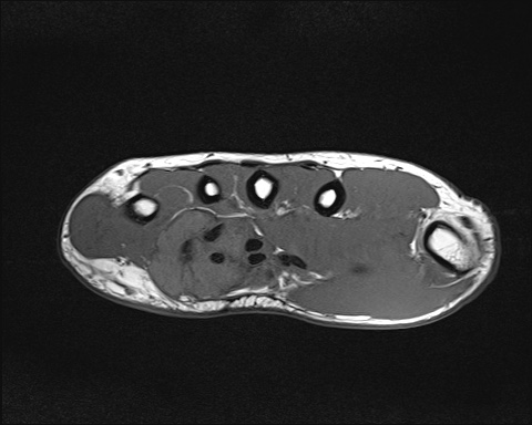 Giant Cell Tumor Of The Tendon Sheath Image Radiopaedia Org