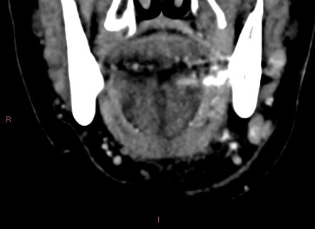 Acute Submandibular Sialadentitis Image Radiopaedia Org