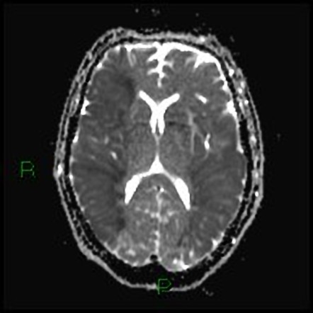 Bilateral Acute Middle Cerebral Artery Territory Infarcts Image