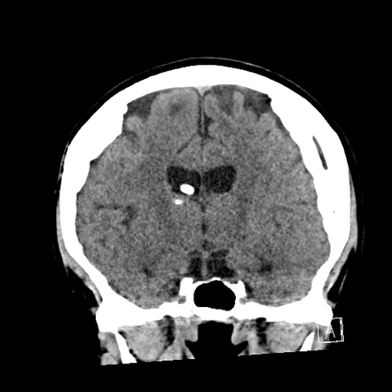 Calcified Chronic Subdural Haematoma Radiology Reference Article Radiopaedia Org